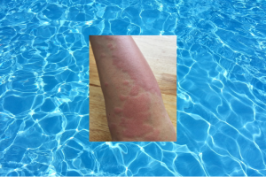 Ilustrasi ruam setelah berenang akibat sensitivitas klorin.